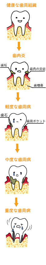歯周病の進行.jpg